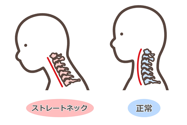 ストレートネックと通常の首の形状の違い
